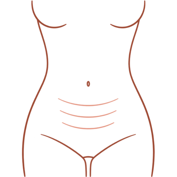 Illustration of a torso marking the abdomen for Thermage FLX skin tightening in London