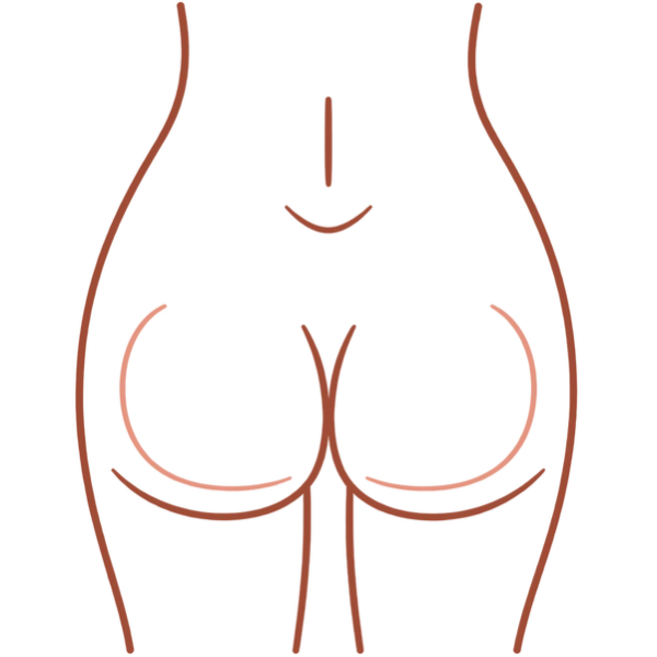 Illustration marking the buttocks for Thermage FLX skin tightening in London